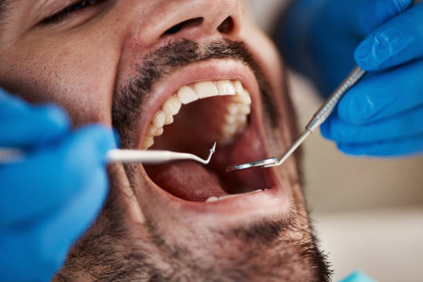 Emergency Dental Filling Replacement in NY