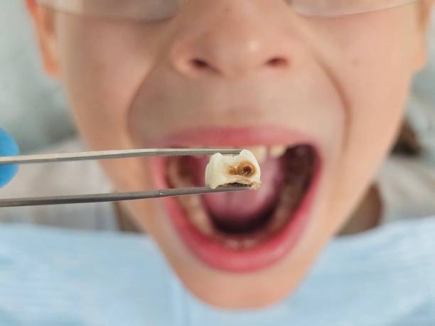 Best Chipped Tooth Repair Near Me  in West Sand Lake, NY